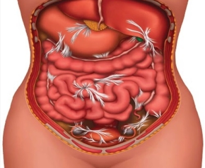 Biến chứng nguy hiểm thủng ổ loét dạ dày – tá tràng khi không được điều trị kịp thời